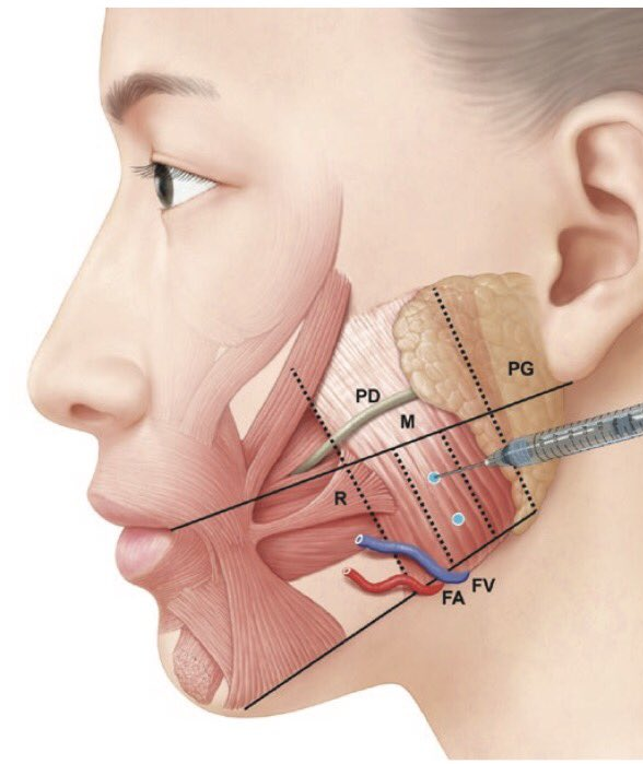 injecții de slăbire a maxilarului